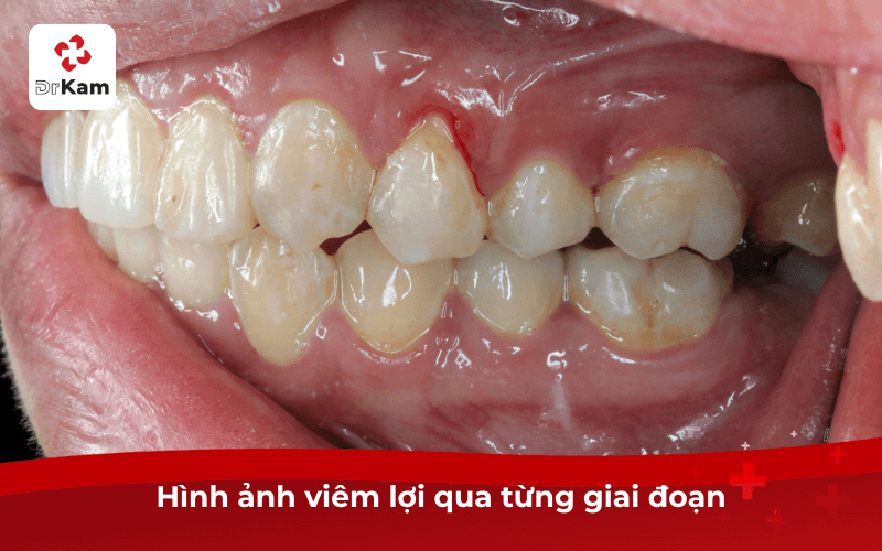 Hình ảnh viêm lợi qua từng giai đoạn