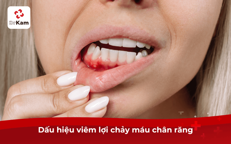 Dấu hiệu viêm lợi chảy máu chân răng