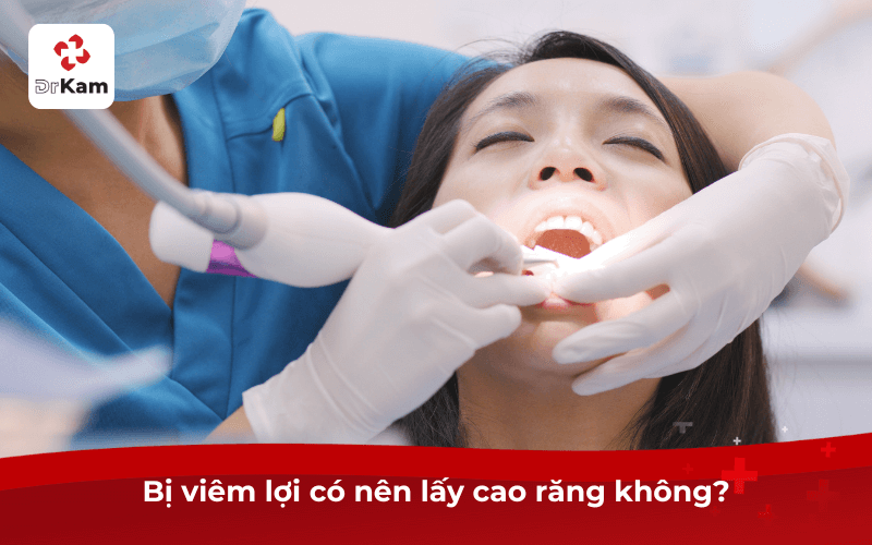 Bị viêm lợi có nên lấy cao răng không?