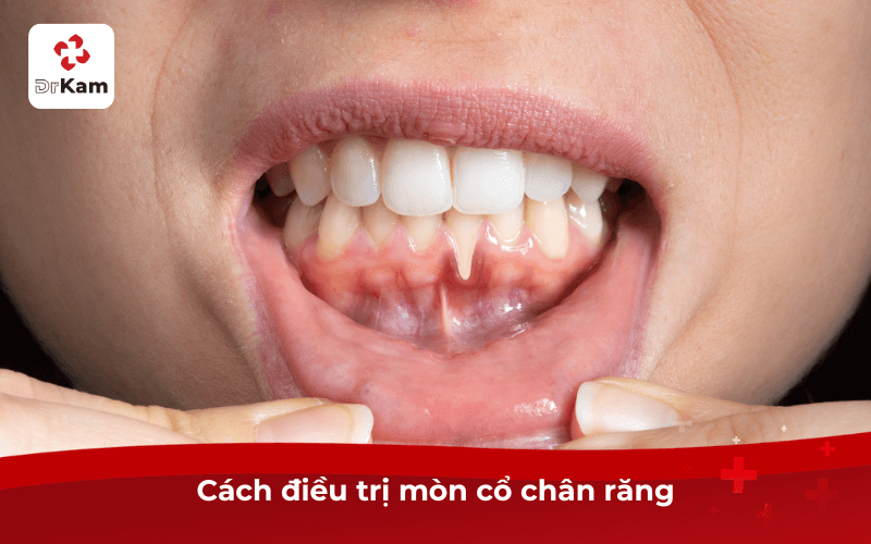 Cách điều trị mòn cổ chân răng