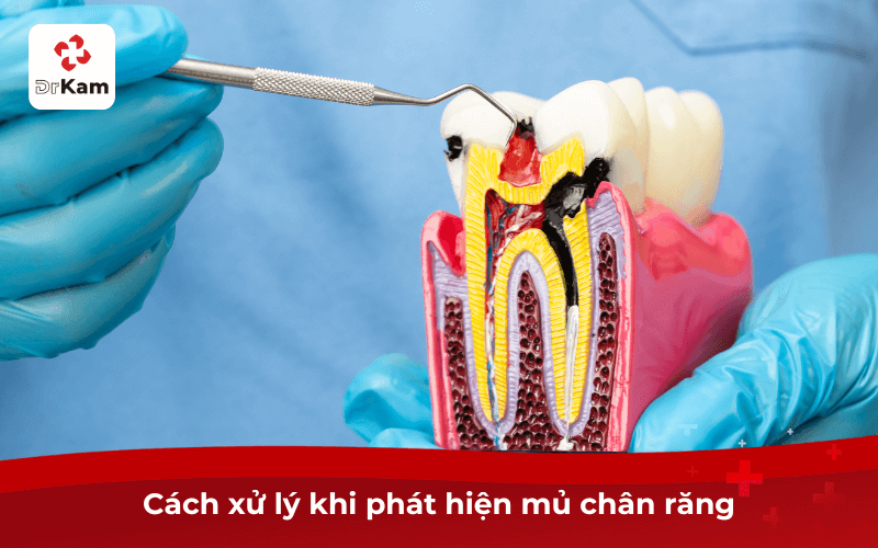 Cách xử lý khi phát hiện mủ chân răng