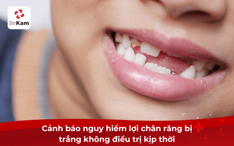 Cảnh báo nguy hiểm lợi chân răng bị trắng không điều trị kịp thời