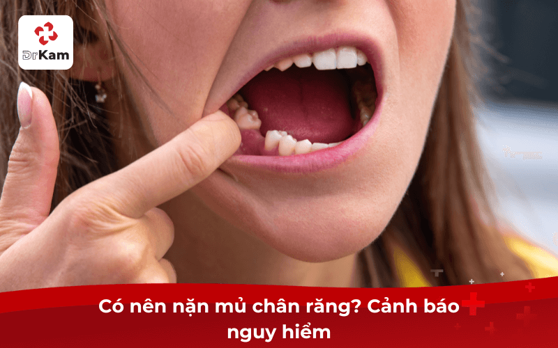 Có nên nặn mủ chân răng? Cảnh báo nguy hiểm