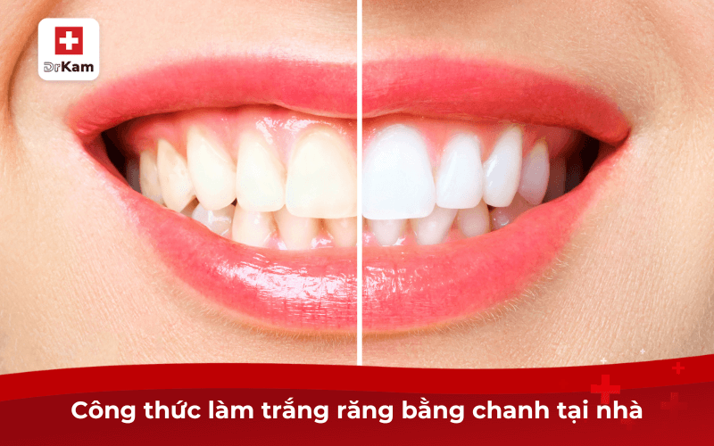 8 cách làm trắng răng bằng chanh hiệu quả thử ngay 5 Cách làm trắng răng bằng chanh tại nhà