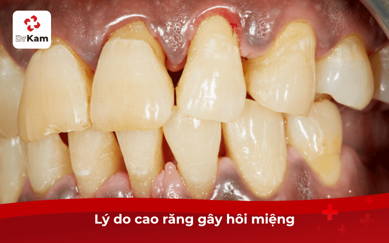 Lý do cao răng gây hôi miệng