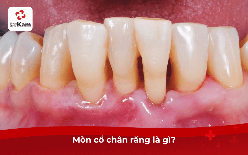 Mòn cổ chân răng là gì?