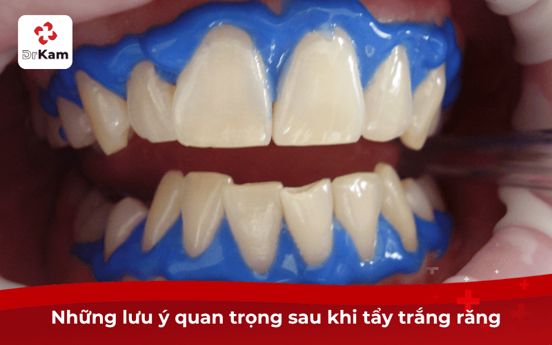 Những lưu ý quan trọng sau khi tẩy trắng răng