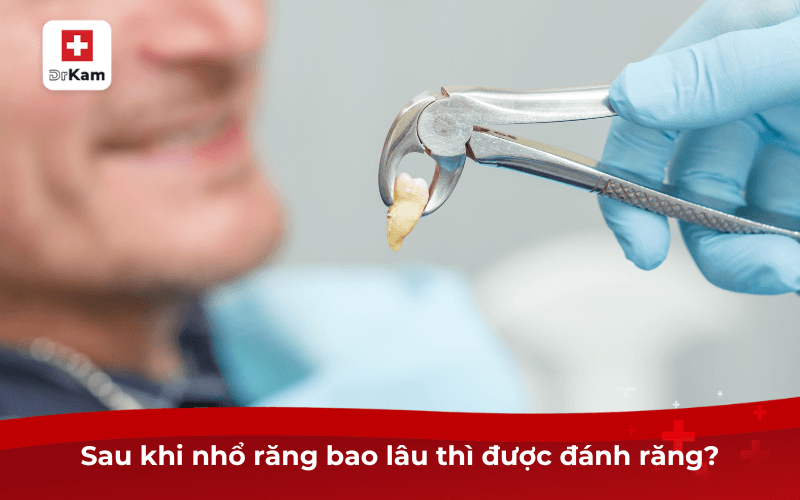 Sau khi nhổ răng bao lâu thì được đánh răng?