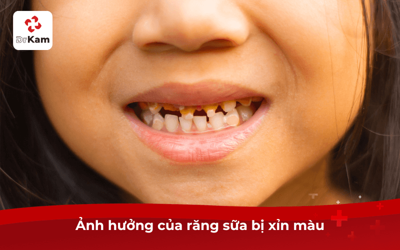 Ảnh hưởng của răng sữa bị xỉn màu
