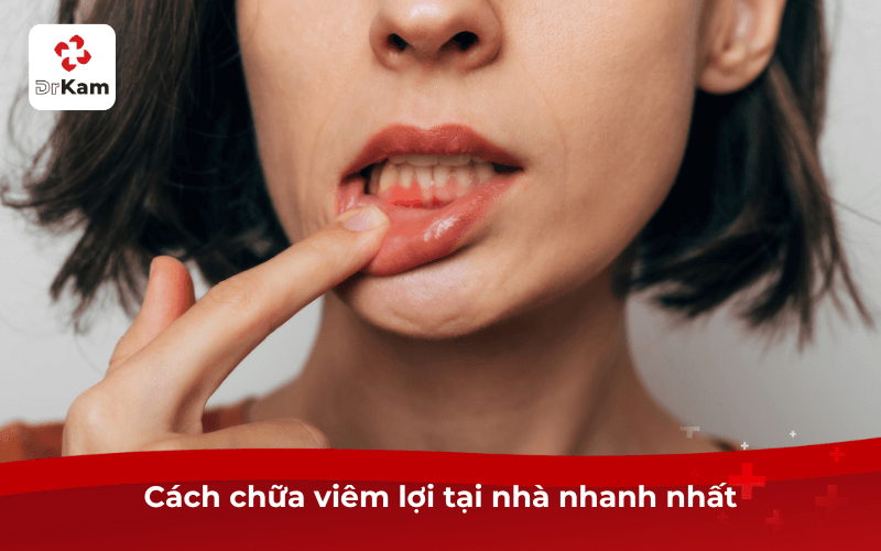 Cách chữa viêm lợi tại nhà nhanh nhất