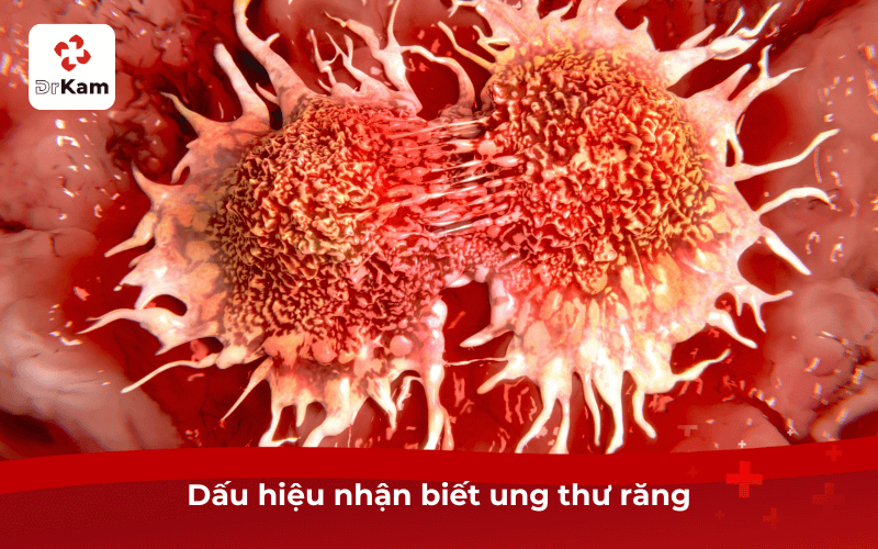 Dấu hiệu nhận biết ung thư răng