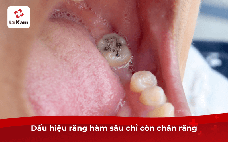 Dấu hiệu răng hàm bị sâu chỉ còn chân răng