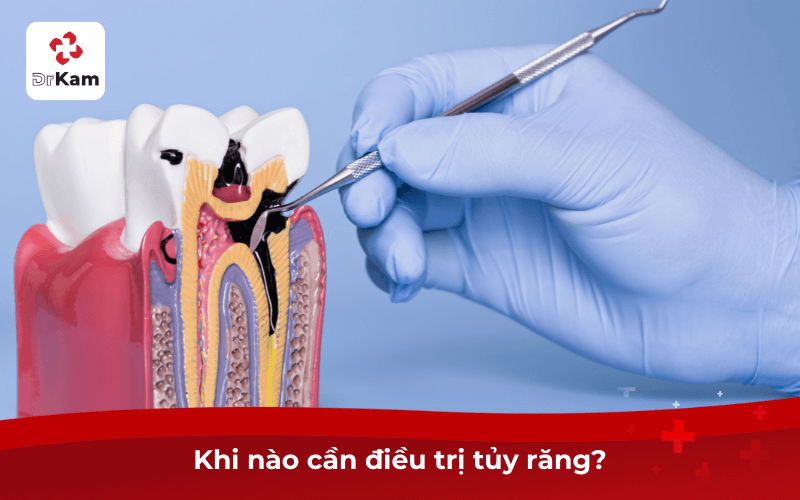 Khi nào cần điều trị tủy răng?