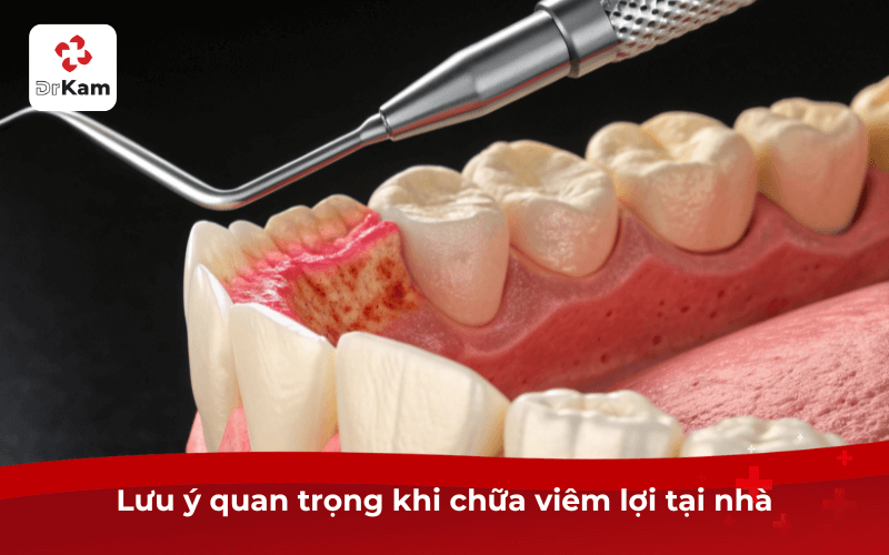 Lưu ý quan trọng khi chữa viêm lợi tại nhà
