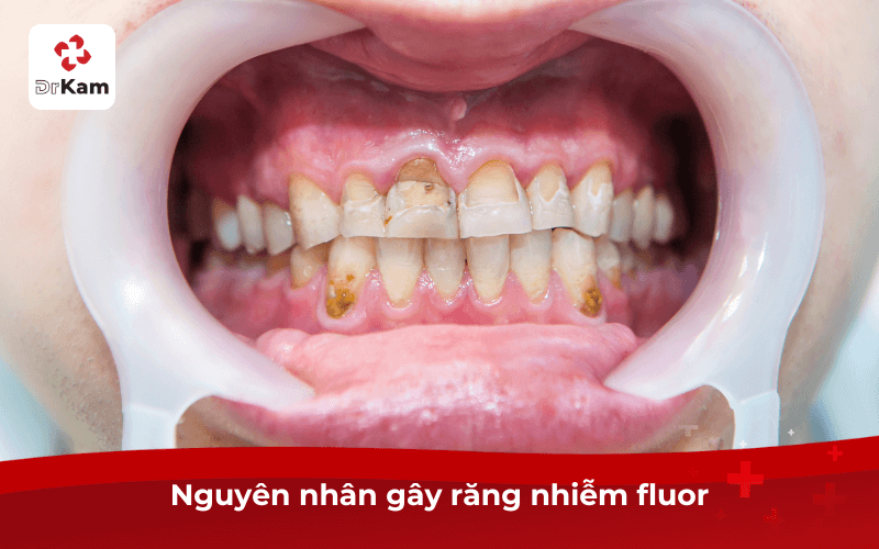 Nguyên nhân gây răng nhiễm fluor