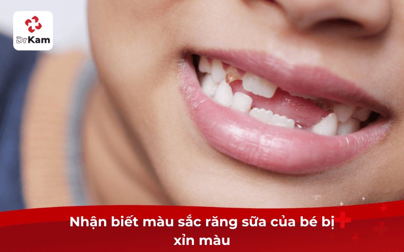 Nhận biết màu sắc răng sữa của bé bị xỉn màu
