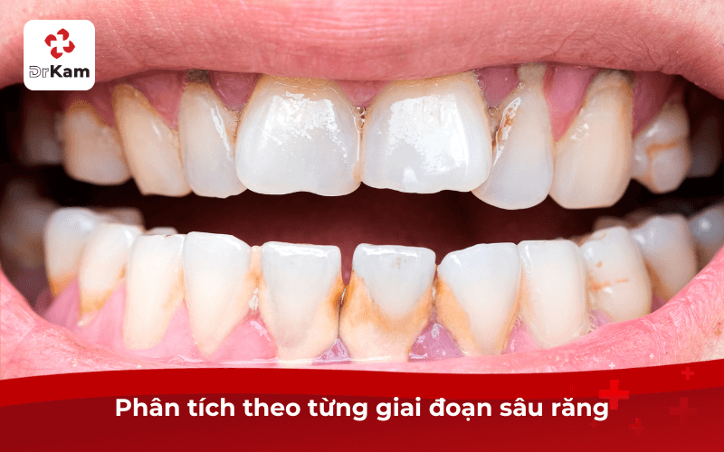 Phân tích theo từng giai đoạn sâu răng