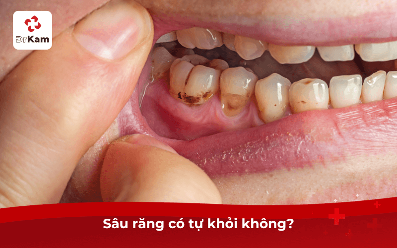 Sâu răng có tự khỏi không?