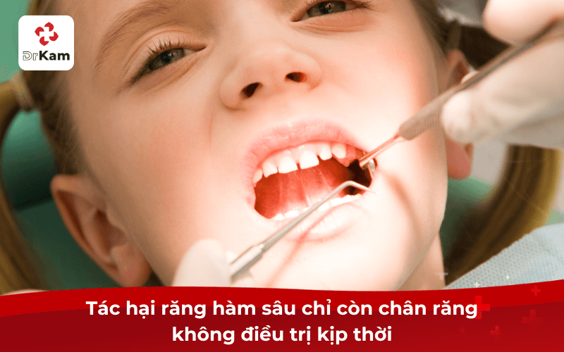 Tác hại răng hàm sâu chỉ còn chân răng không điều trị kịp thời