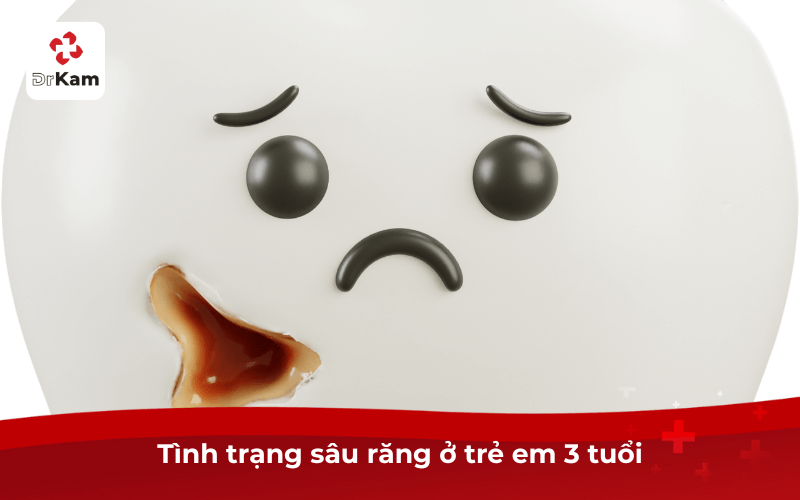 Cảnh báo sâu răng ở trẻ em 3 tuổi nguy hiểm? Dấu hiệu, cách điều trị và phòng ngừa 5 Tình trạng sâu răng ở trẻ em 3 tuổi