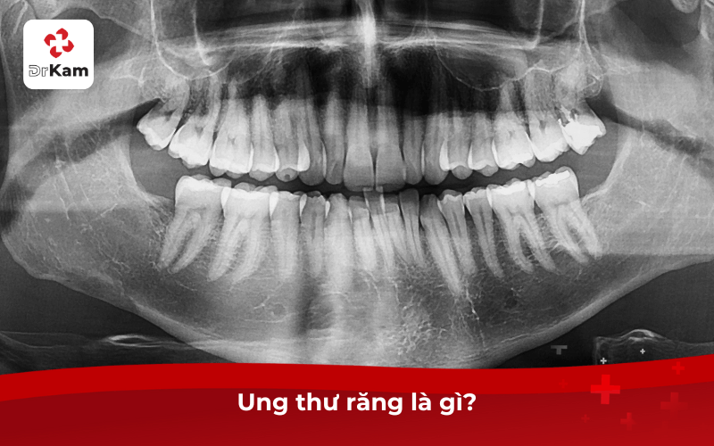 Ung thư răng là gì?