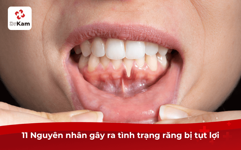 Tụt lợi nguy hiểm không? Nguyên nhân và 10 cách xử lý hiệu quả thực hiện ngay 4 11 Nguyên nhân gây ra tình trạng răng bị tụt lợi