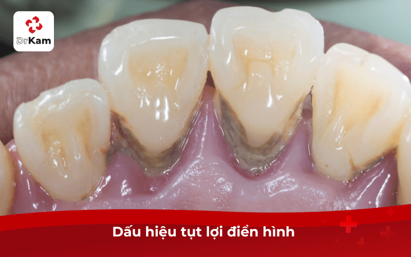 Cảnh báo 12 dấu hiệu tụt lợi cần điều trị ngay lập tức 5 Dấu hiệu tụt lợi điển hình