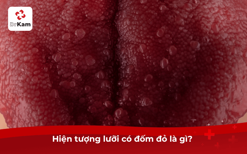 Tôi thấy lưỡi có đốm đỏ sao không? Nguyên nhân, mức độ nguy hiểm và cách khắc phục hiệu quả 5 Hiện tượng lưỡi có đốm đỏ là gì?