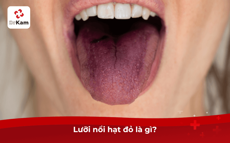 Tôi bị lưỡi nổi hạt đỏ? Nguyên nhân, cách điều trị và chăm sóc hiệu quả sau 1 đêm 4 Lưỡi nổi hạt đỏ là gì?