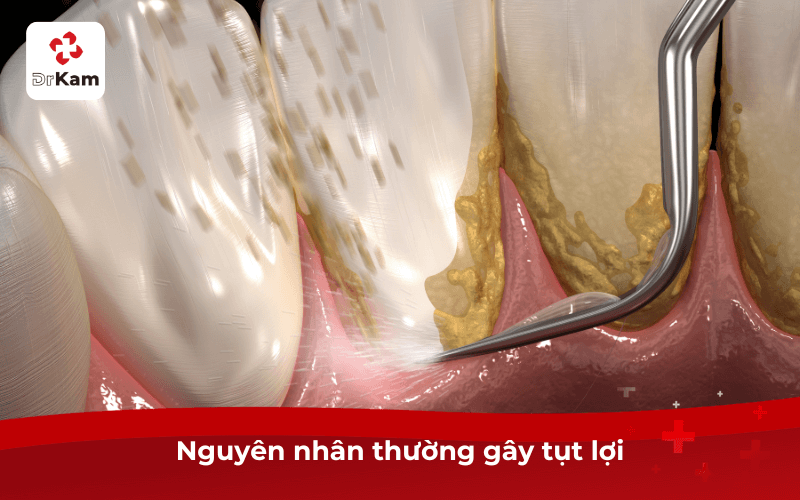 Cảnh báo 12 dấu hiệu tụt lợi cần điều trị ngay lập tức 6 Nguyên nhân thường gây tụt lợi