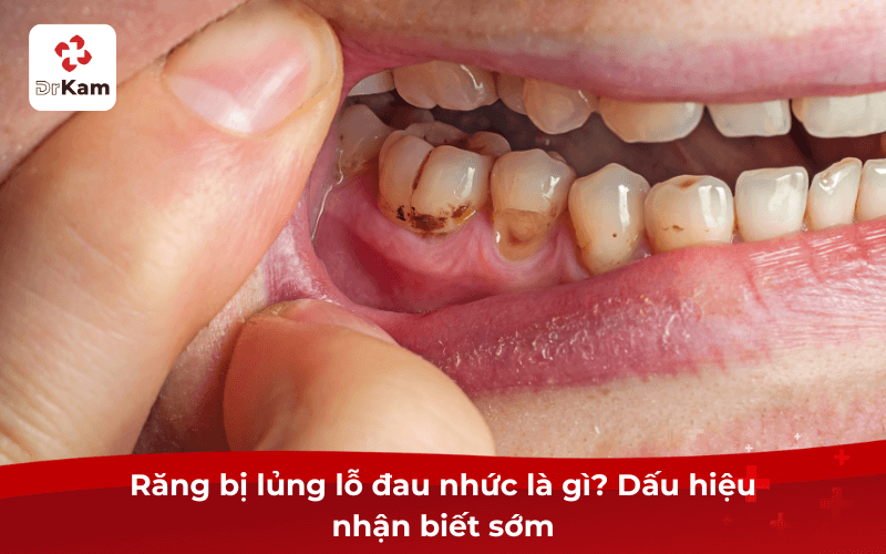 Răng bị lủng lỗ đau nhức là gì? Dấu hiệu nhận biết sớm