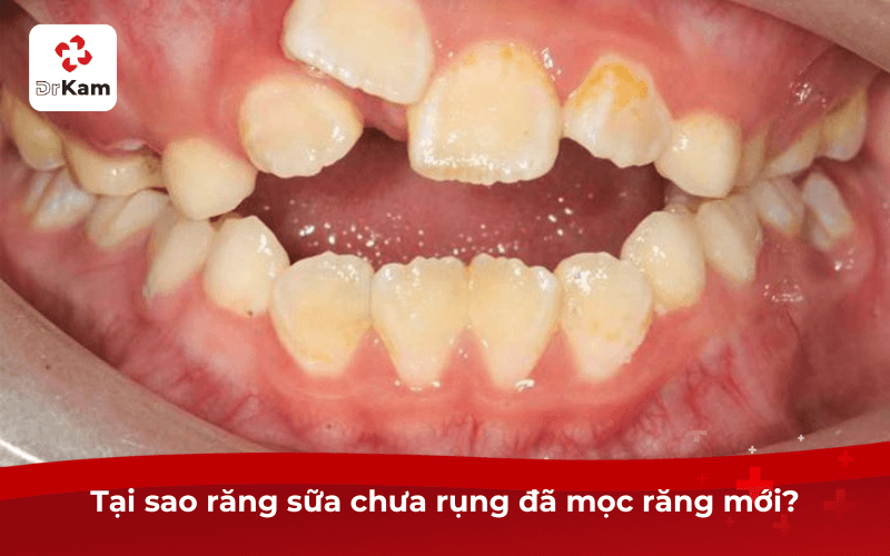 Tại sao răng sữa chưa rụng đã mọc răng mới?