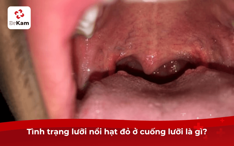 Cảnh báo lưỡi nổi hạt đỏ ở cuống lưỡi nguy hiểm? Nguyên nhân và cách xử lý hiệu quả 4 Tình trạng lưỡi nổi hạt đỏ ở cuống lưỡi là gì?