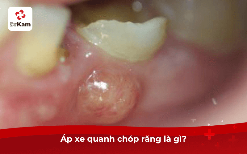 Áp xe quanh chóp răng là gì?