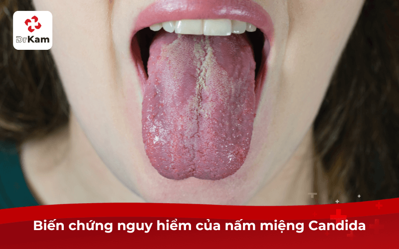 Nấm miệng Candida là gì? Triệu chứng, nguyên nhân và cách điều trị phòng ngừa 6 Biến chứng nguy hiểm của nấm miệng Candida