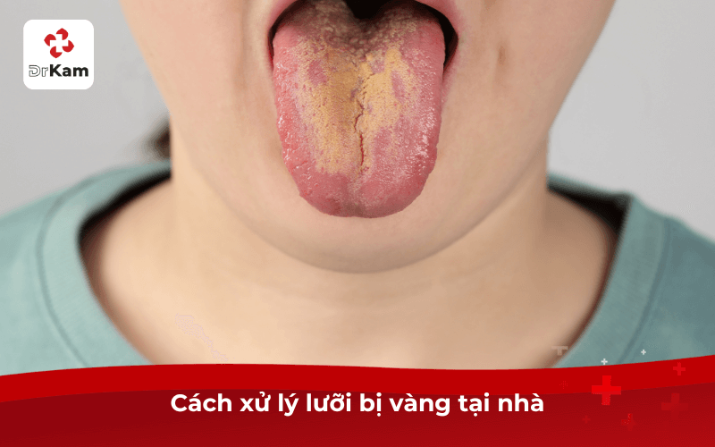 Lưỡi vàng - Triệu chứng, 4 cách xử lý và biện pháp cải thiện hiệu quả 4 Cách xử lý lưỡi vàng tại nhà