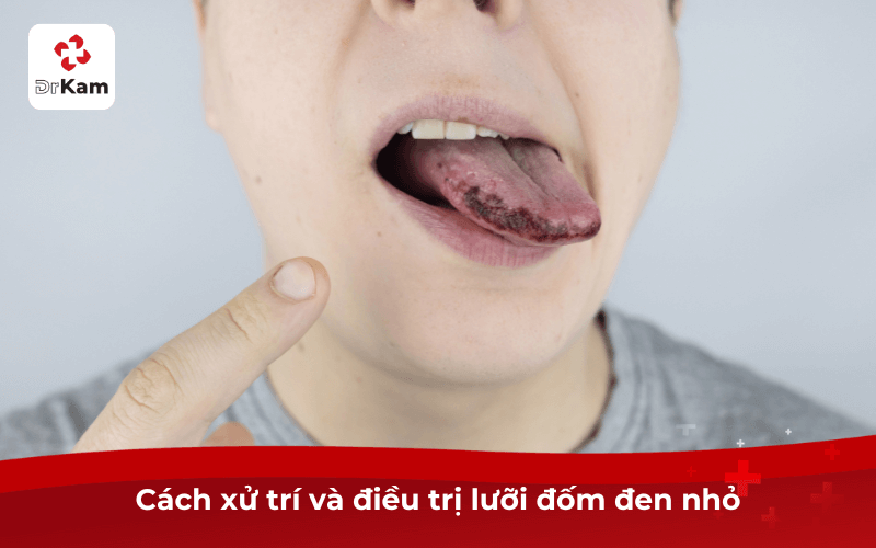 Cách xử trí và điều trị lưỡi đốm đen nhỏ