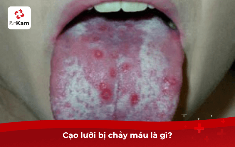 Cạo lưỡi bị chảy máu là gì?
