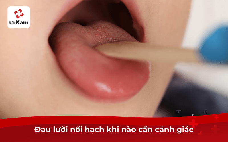 Đau lưỡi nổi hạch khi nào cần cảnh giác