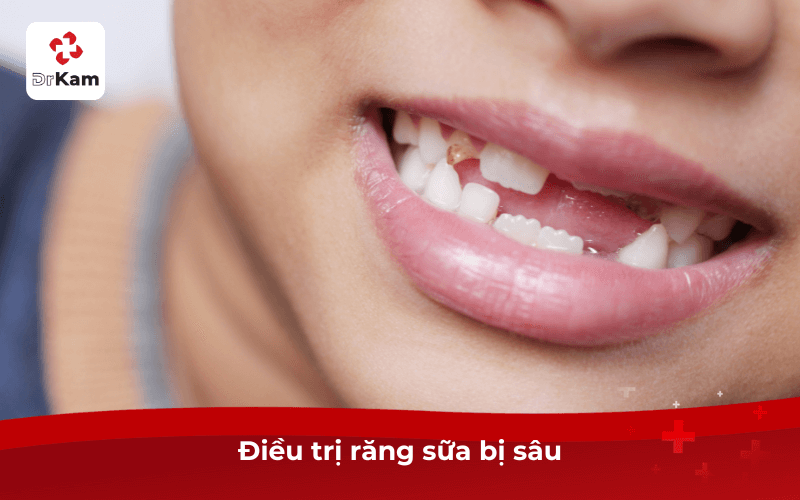 Điều trị răng sữa bị sâu