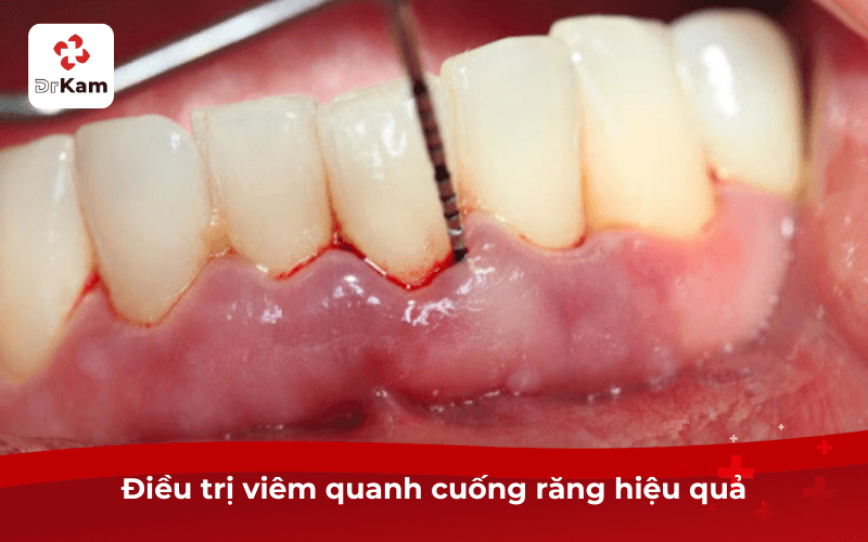 Điều trị viêm quanh cuống răng hiệu quả