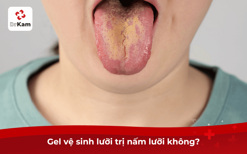 Gel vệ sinh lưỡi trị nấm lưỡi không?