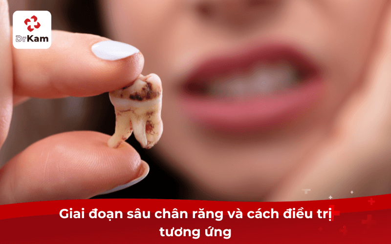 Giai đoạn sâu chân răng và cách điều trị tương ứng