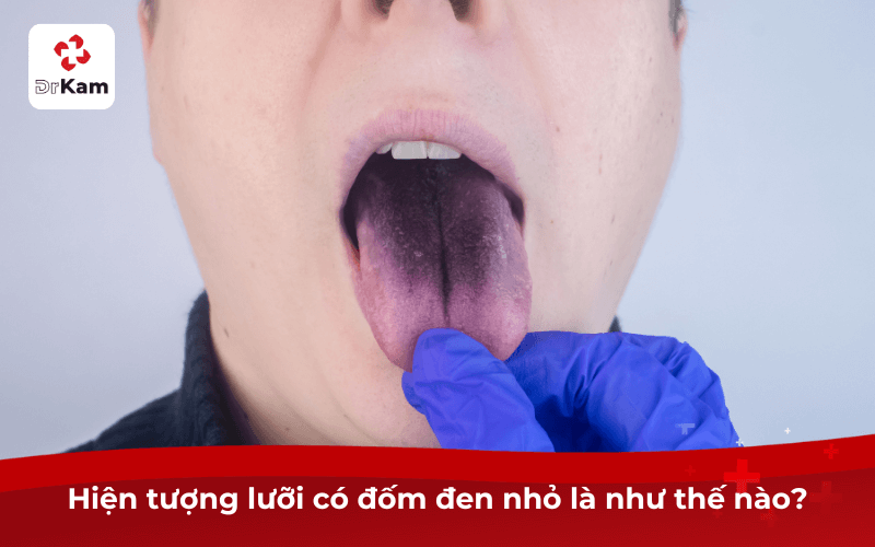 Hiện tượng lưỡi có đốm đen nhỏ là như thế nào?