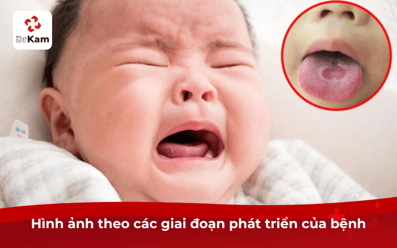 Hình ảnh theo các giai đoạn phát triển của bệnh