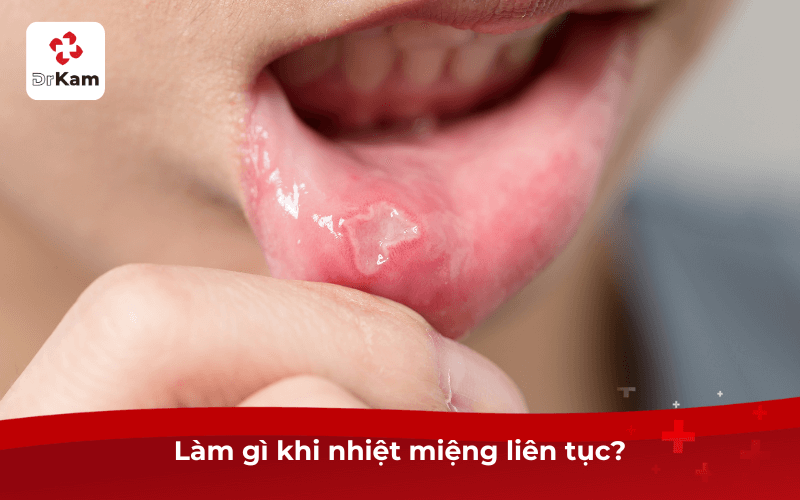 Làm gì khi bị nhiệt miệng liên tục?
