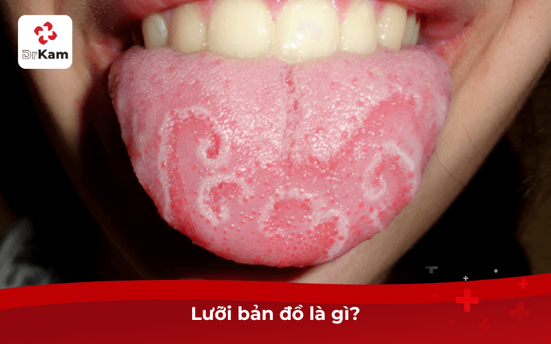 Lưỡi bản đồ là gì? Nguyên nhân, triệu chứng, phương pháp và cách phòng ngừa hiệu quả 5 Lưỡi bản đồ là gì?