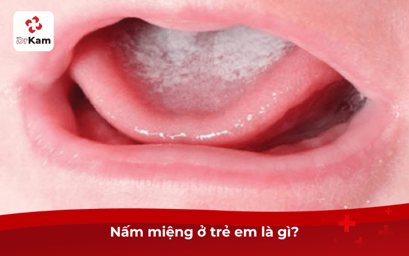 Nấm miệng ở trẻ em là gì?