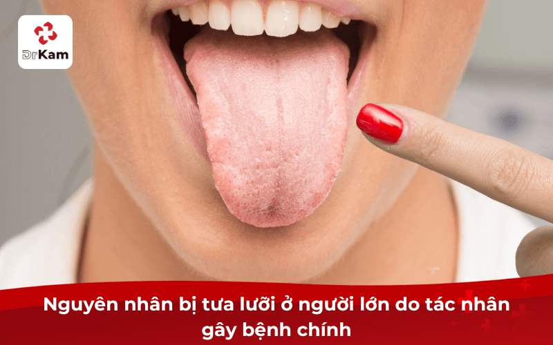 6 Nguyên nhân bị tưa lưỡi ở người lớn “Điển hình” nhất định phải biết và cách phòng ngừa 4 Nguyên nhân bị tưa lưỡi ở người lớn do tác nhân gây bệnh chính