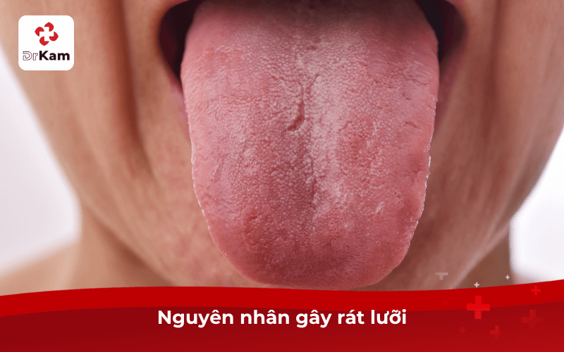 Nguyên nhân gây rát lưỡi